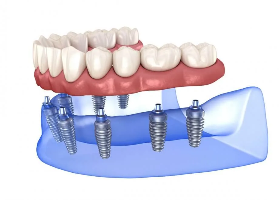 Type of dental implants