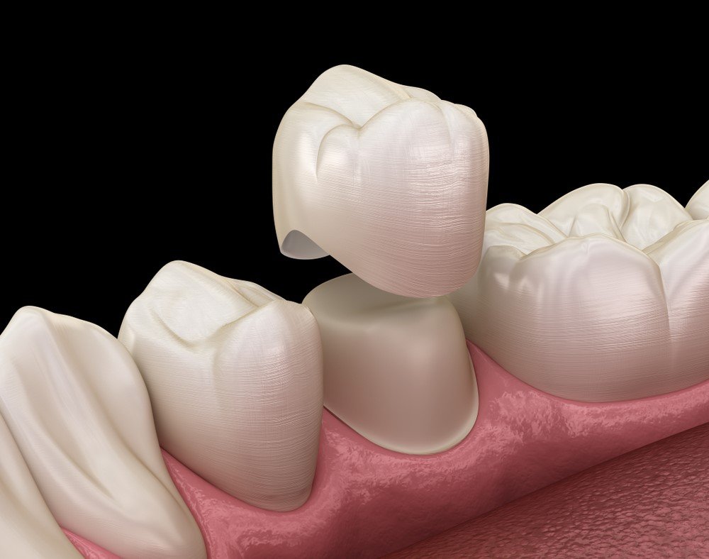 Porcelain Crowns