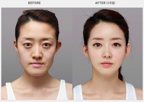 plastice surgery beafore & after