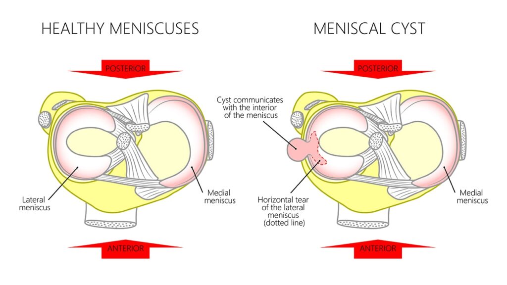 Meniscal Cysts