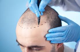 best hair transplant in lahore