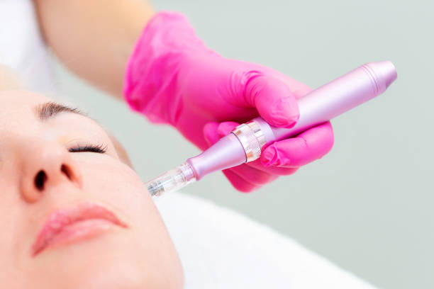 Fractional RF Microneedling in Abu Dhabi