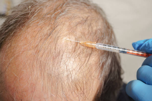 Scalp Micropigmentation in Abu Dhabi