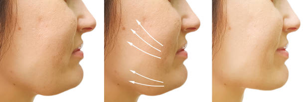 Jawline Filler Injections in Abu Dhabi