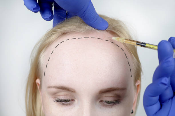 Female Hair Transplant in Abu Dhabi