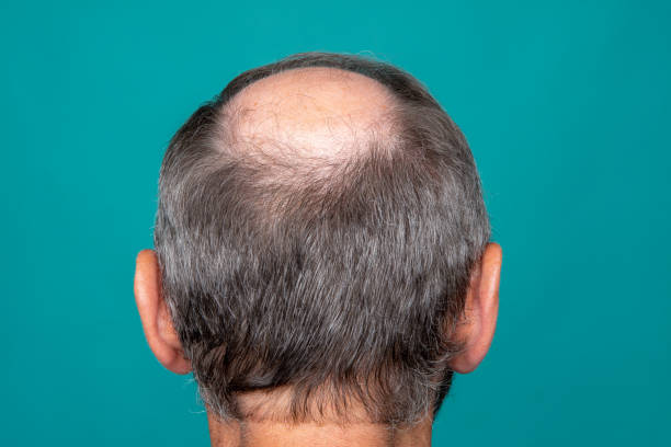 Fuss Hair Transplant in Abu Dhabi