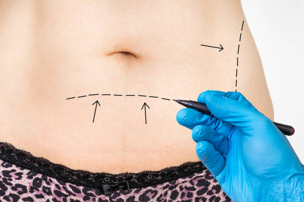 Mini Abdominoplasty in Abu Dhabi