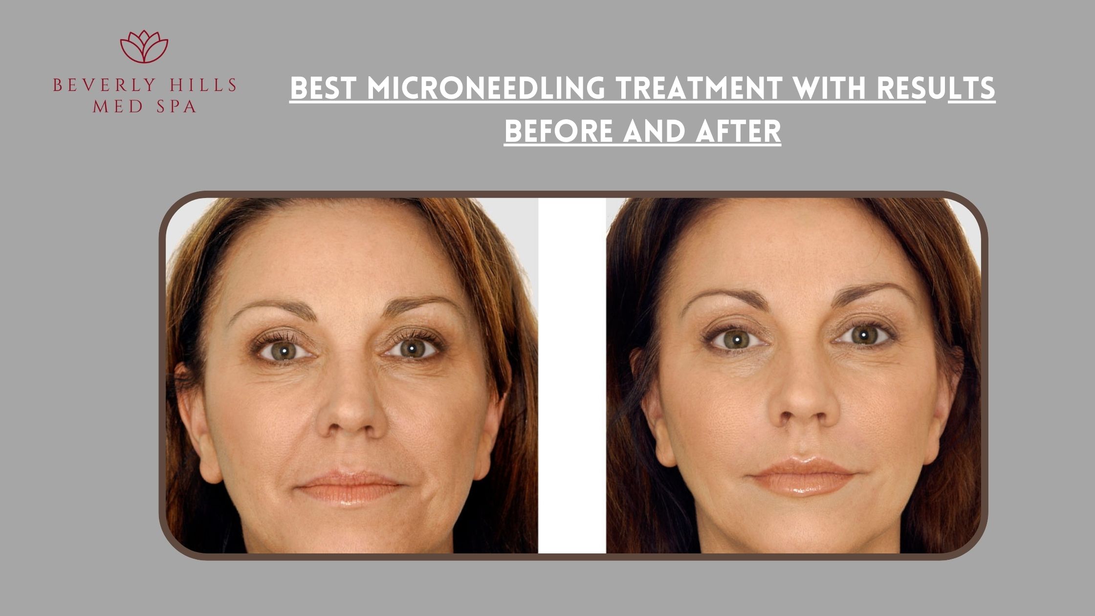 microneedling before and after wrinkles