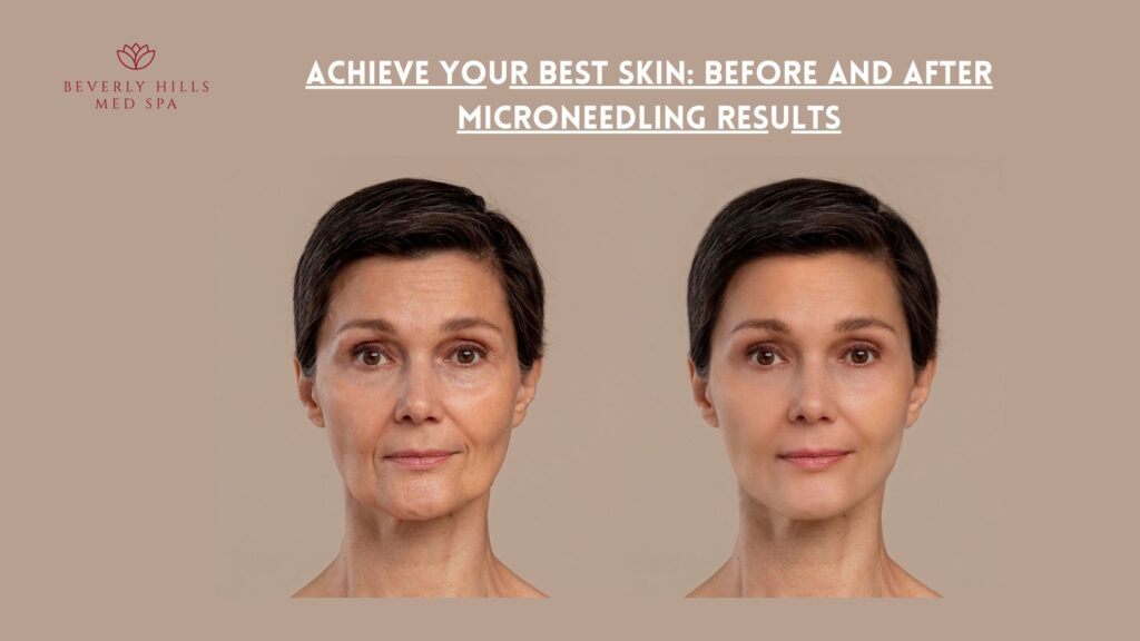 microneedling before and after wrinkles