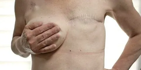 Breast cancer surgery in india