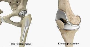 Dr. Shohab's Approach to Treating Torn Ligaments in Sports Injuries in Karachi