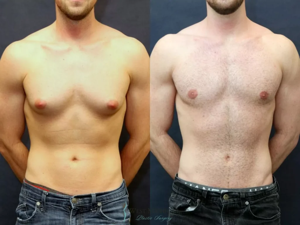 Best Gynecomastia Surgeons in Dubai