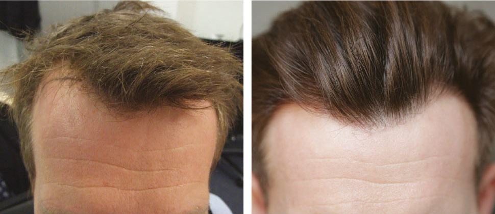 Choosing the right hair transplant surgeon is a critical step in ensuring the success of your procedure. With numerous clinics and specialists offering their services in London, it can be challenging to determine who is best suited to meet your needs. A top hair transplant surgeon possesses several qualities that set them apart, including their expertise, approach to patient care, and ability to deliver natural, long-lasting results. In this article, we'll explore what makes a top hair transplant london and how you can identify the best professional for your hair restoration journey. Extensive Experience and Qualifications Professional Training and Certification A top hair transplant surgeon in London will have undergone extensive medical training and earned certifications from reputable institutions. Surgeons typically hold qualifications in dermatology, plastic surgery, or other relevant medical fields, ensuring they have a strong foundation in anatomy, patient care, and surgical techniques. In addition to formal education, a reputable surgeon will also be accredited by professional organizations such as the International Society of Hair Restoration Surgery (ISHRS) or the British Association of Hair Restoration Surgery (BAHRS). These certifications demonstrate that the surgeon adheres to high standards and is committed to ongoing professional development. Years of Experience and Specialization Experience plays a significant role in the success of hair transplant surgeries. Top surgeons typically have many years of practice and a significant number of successful procedures under their belt. Surgeons who specialize exclusively in hair restoration surgery are more likely to have refined techniques and a deep understanding of the intricacies of hair transplant procedures. Choosing a surgeon who specializes in hair restoration ensures that you’re benefiting from their focused expertise. Knowledge of the Latest Techniques and Technologies Mastery of Advanced Hair Transplant Methods Hair transplant surgery has come a long way in recent years, with innovative techniques such as Follicular Unit Extraction (FUE) and Follicular Unit Transplantation (FUT) replacing older methods. A top hair transplant surgeon in London should be well-versed in these cutting-edge techniques and know when and how to apply each one based on the individual patient's needs. Surgeons who stay up to date with industry trends, attending conferences and workshops, demonstrate their commitment to providing the best possible care. FUE, for example, is a minimally invasive method that allows for individual hair follicles to be extracted and transplanted without the need for large incisions, resulting in quicker healing and minimal scarring. A top surgeon will know how to use these methods to achieve natural-looking results with minimal downtime. Use of Robotic and High-Tech Tools Many of the top hair transplant clinics in London are equipped with the latest robotic-assisted technologies that help ensure precision and accuracy during the procedure. Robotic systems like the ARTAS® system use advanced algorithms to identify and extract healthy hair follicles with great precision, offering a higher level of consistency than traditional manual techniques. A top surgeon will not only be familiar with these technologies but will also use them to enhance the quality of the results for patients. Personalized Patient Care and Consultations Thorough Consultation and Transparent Communication A leading hair transplant surgeon will offer a comprehensive consultation to discuss your concerns, assess your hair loss, and develop a personalized treatment plan. They should take the time to explain the available treatment options, answer your questions, and set realistic expectations for the outcome. A transparent surgeon will also provide clear details about the cost, recovery process, and potential risks associated with the procedure. It's important to feel comfortable and informed throughout the consultation process, as this establishes trust and ensures you are making an educated decision. Empathy and Patient-Centered Approach Beyond surgical skills, a top hair transplant surgeon will prioritize patient care. They should demonstrate empathy and understand the emotional and psychological effects of hair loss. A surgeon who listens attentively to your concerns and provides guidance with sensitivity can help alleviate any anxiety and ensure you feel supported throughout the process. The relationship between patient and surgeon plays a vital role in achieving successful results. Proven Track Record of Success Before-and-After Photos and Testimonials One of the most effective ways to gauge the quality of a hair transplant surgeon’s work is by looking at their portfolio of before-and-after photos of previous patients. Reputable surgeons will have an extensive gallery of high-quality images showcasing their work. These photos can give you a clear idea of the kind of results you can expect, whether you’re undergoing a slight hairline restoration or a full scalp transplant. In addition to visual evidence, testimonials from former patients can offer valuable insights into the surgeon’s skill, patient care, and overall experience. Reading reviews and seeking recommendations from others who have undergone the procedure can give you confidence in your choice of surgeon. High Success Rate and Satisfied Patients A top surgeon will have a high success rate and a long list of satisfied clients who have achieved their desired results. While every patient’s outcome will vary based on individual factors, a good surgeon should be able to consistently deliver excellent results for the majority of their patients. This track record of success is a key indicator of the surgeon's ability and dedication to their craft. Comprehensive Aftercare and Follow-Up Post-Procedure Care Hair transplant surgery doesn’t end once the procedure is complete. A top surgeon in London will offer comprehensive aftercare services to ensure the best results. This includes providing detailed instructions on post-surgery care, offering follow-up appointments, and addressing any complications or concerns that arise during recovery. Surgeons who prioritize aftercare will also guide you through the shedding phase (when transplanted hair may temporarily fall out) and reassure you that regrowth is normal. Managing Expectations and Long-Term Support A top hair transplant surgeon will take the time to manage your expectations throughout the recovery process. Since hair growth can take months to show noticeable results, it’s essential to have regular follow-ups to monitor progress and make adjustments if necessary. A surgeon who offers ongoing support helps ensure you are satisfied with your results and that any concerns are addressed in a timely manner. Conclusion hair-transplants-london-clinic