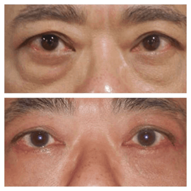Eye bag Removal