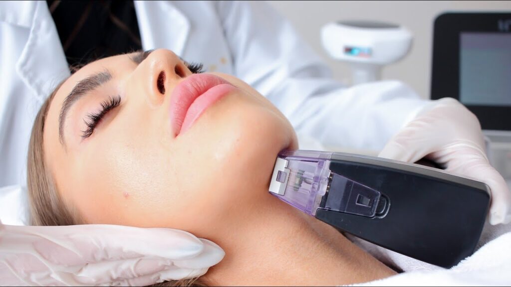 Morpheus8 RF microneedling