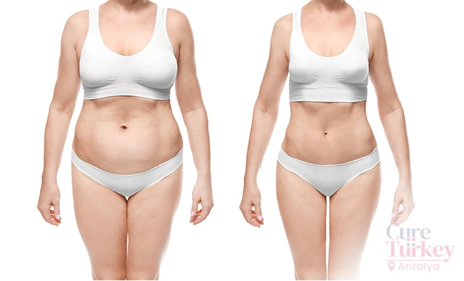 VASER liposuction in Turkey