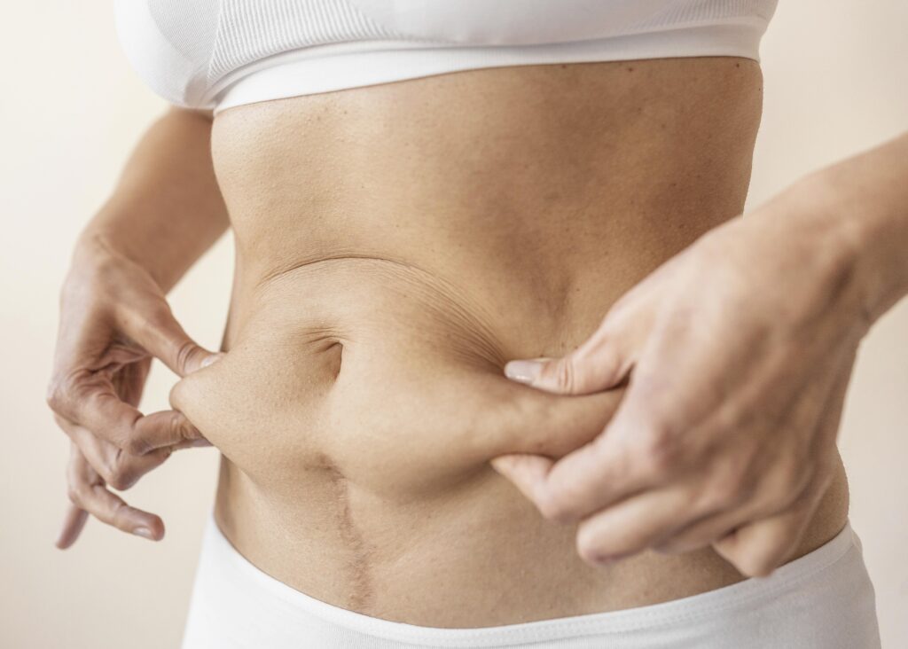 Liposuction in Dubai for Post Pregnancy Body Transformation