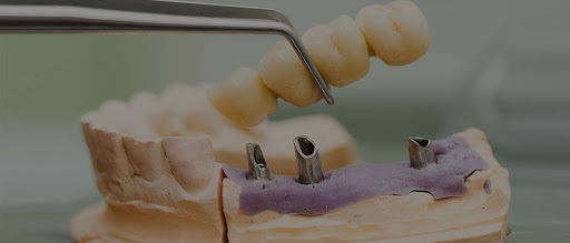 Dental Implant Surgery Houston