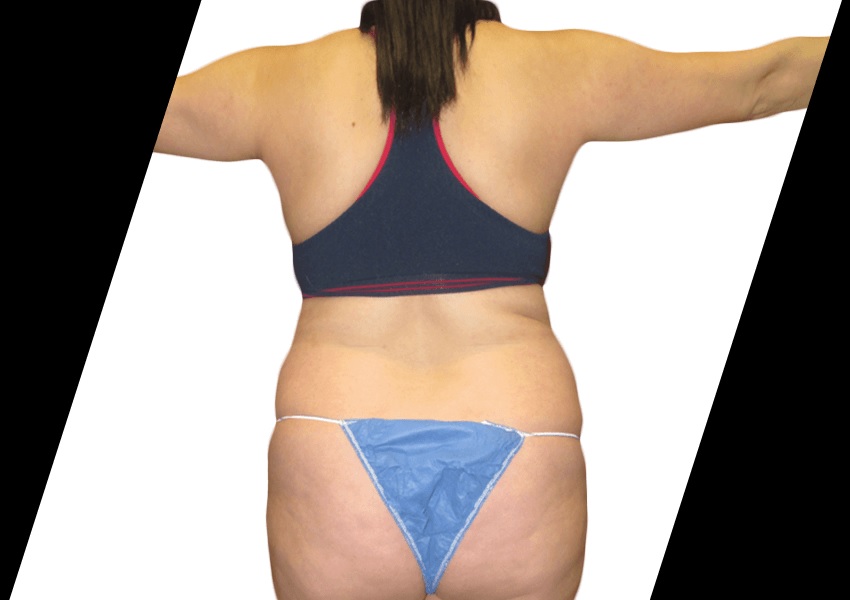 thigh lift in houston tx