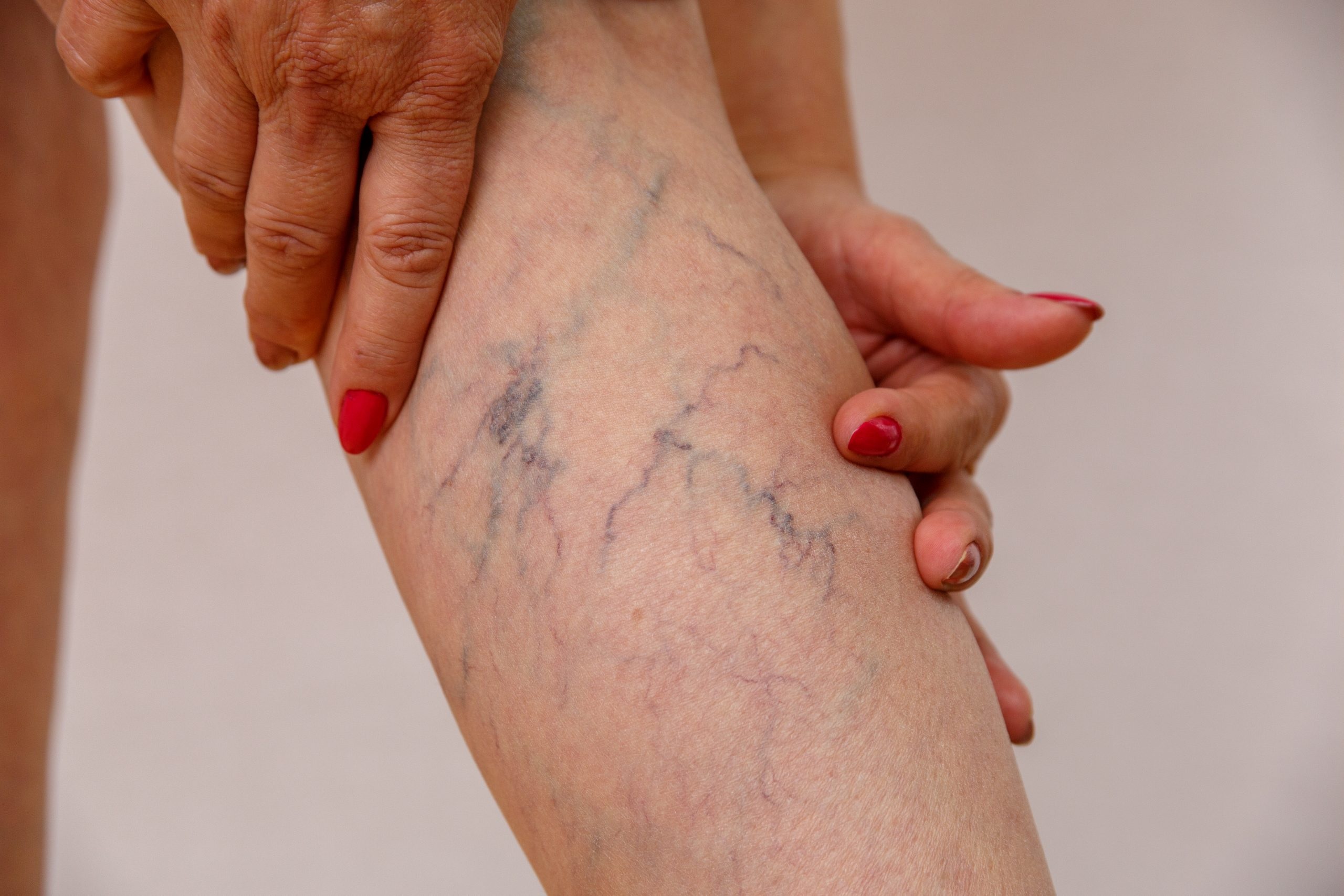 Vein Treatment in Long Island
