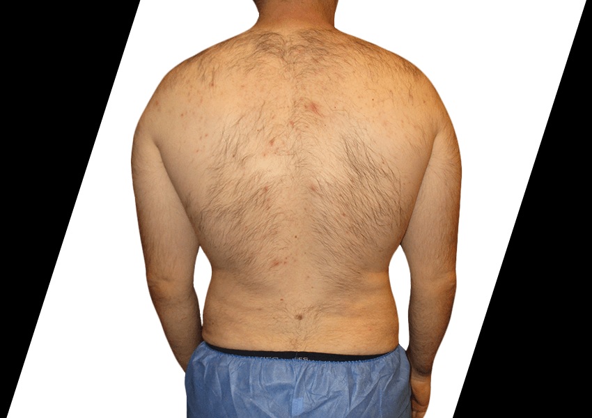 fat transfer to breast houston tx