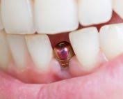 fixed full arch dental implants