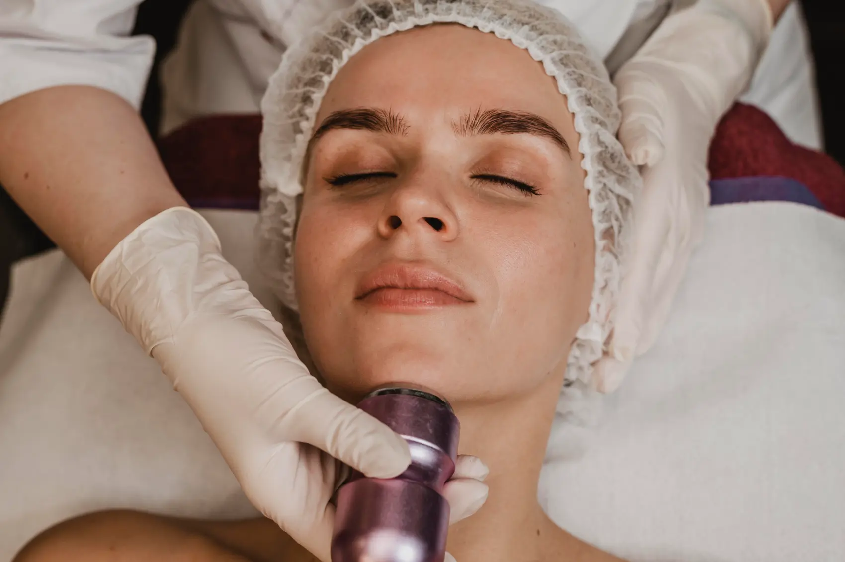 Microneedling Toronto