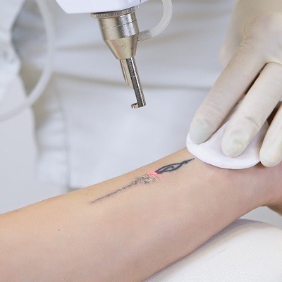 Start A New Journey With Laser Tattoo Removal