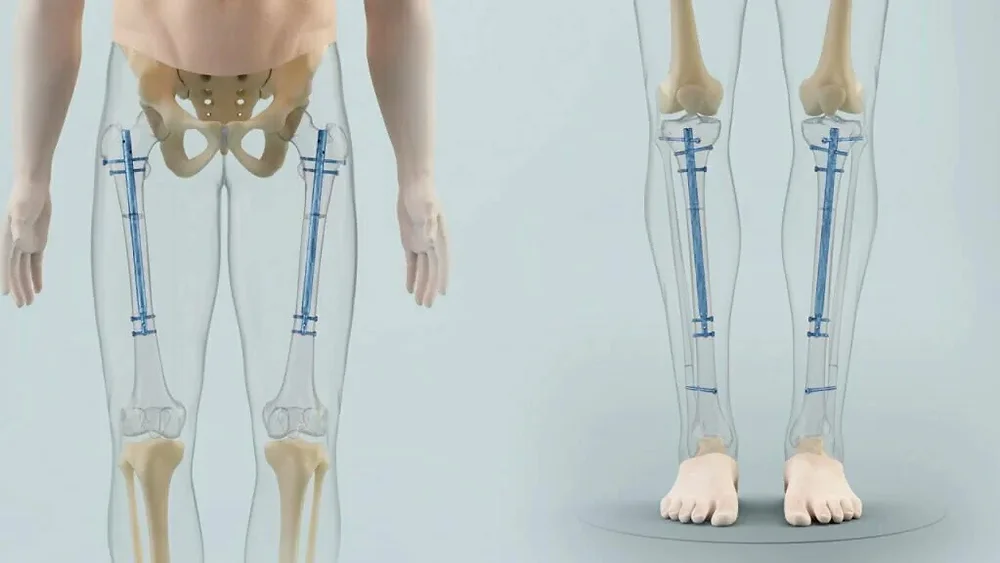 limb lengthening surgery