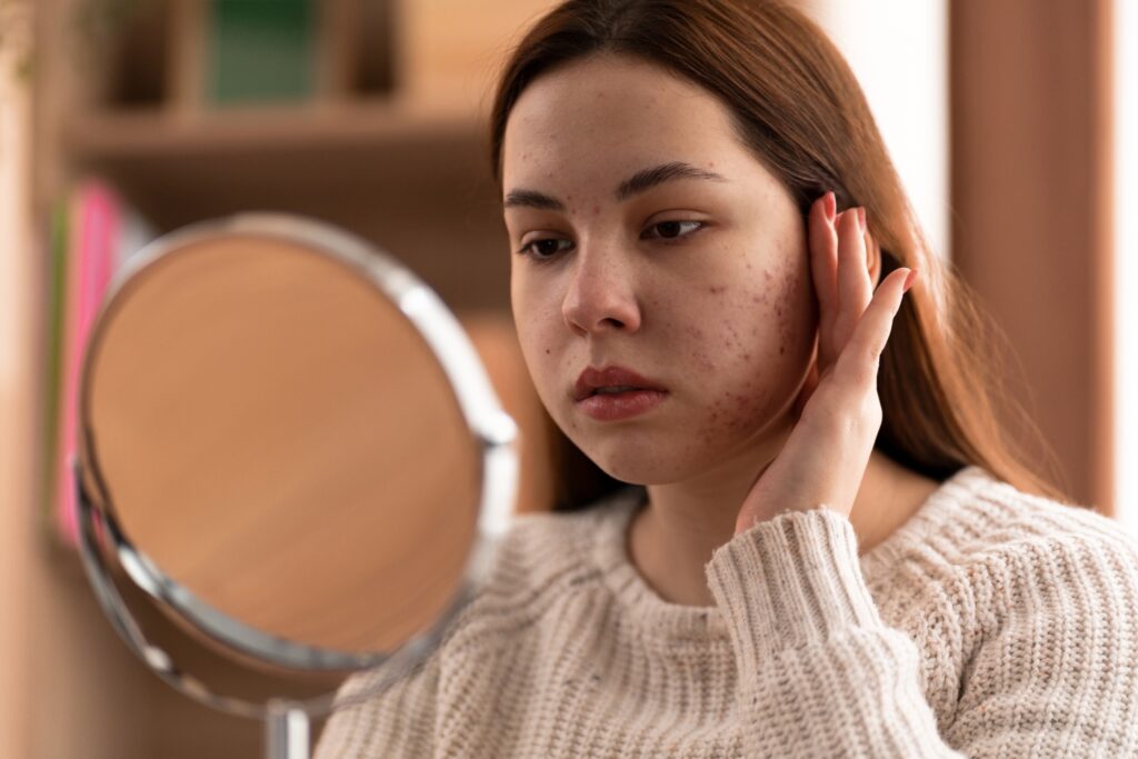 acne scar treatment