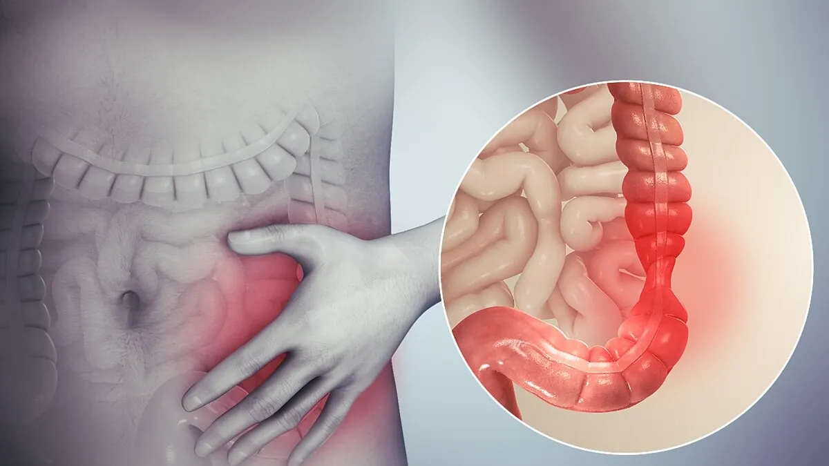 colonoscopy