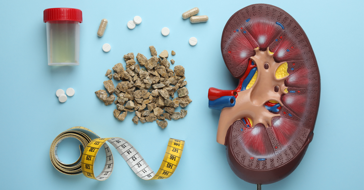 kidney stone treatment in Delhi