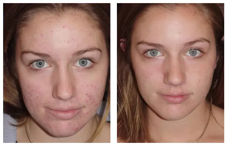 microneedling with radiofrequency