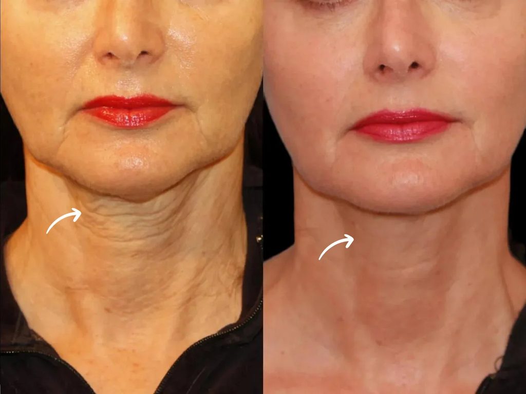 Sculptra in dubai