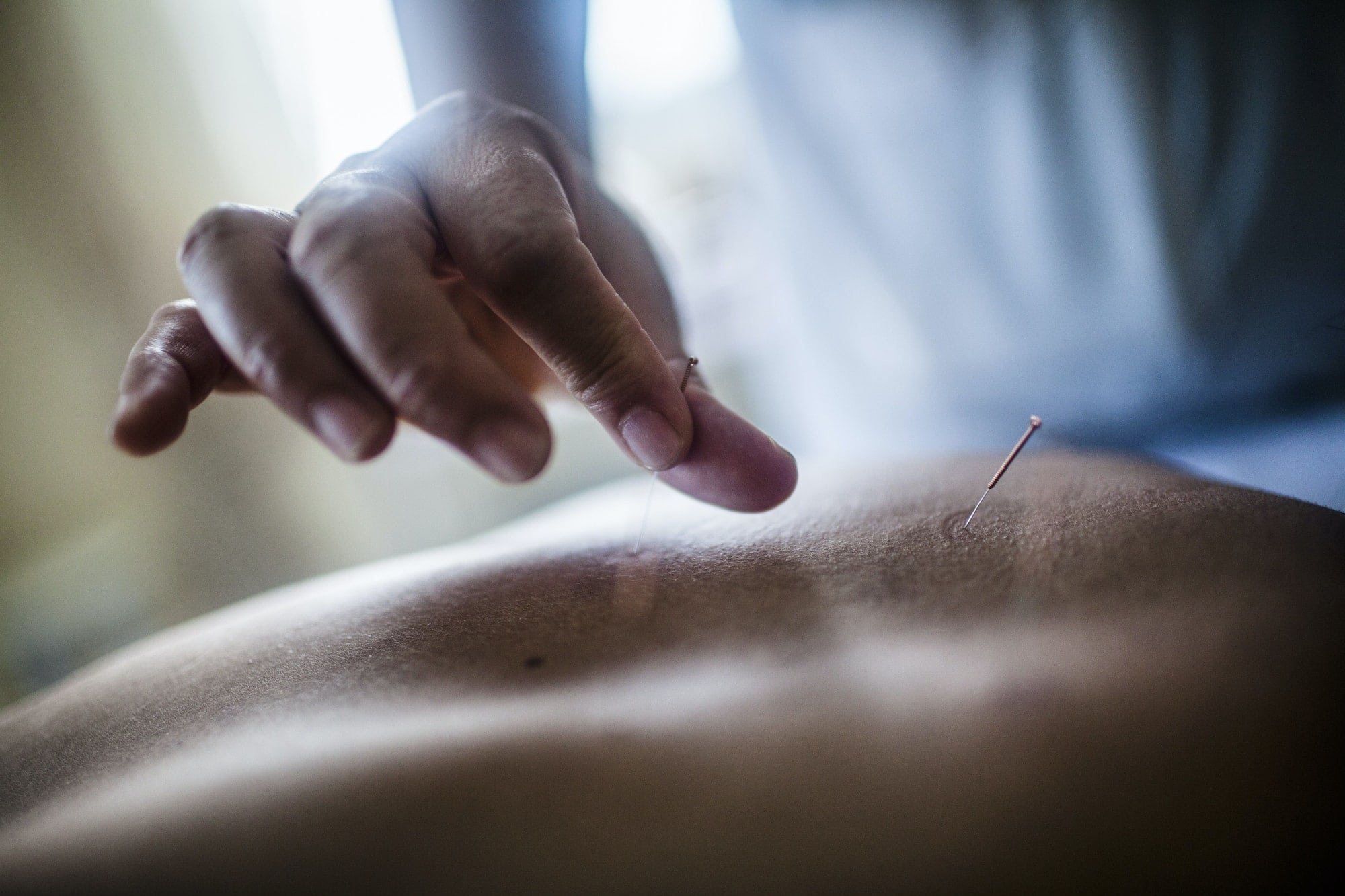 Acupuncture For Pain Relief NYC/Acupuncture Treatment For Pain NYC